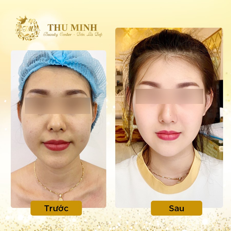 Độn cằm v line vĩnh viễn công nghệ chuẩn Hàn Quốc